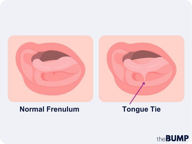 Tongue-Tie-Assessment-and-Osteopathic-Support-for-Babies-img-a