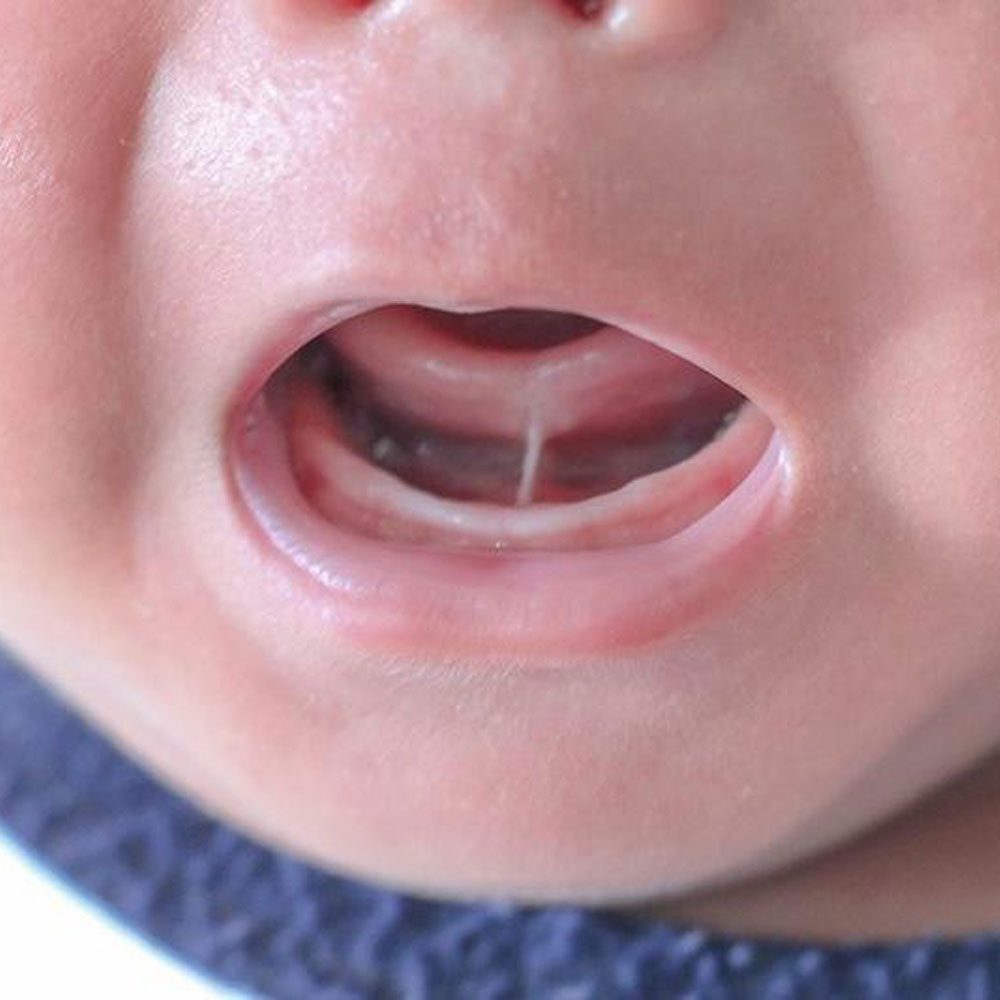 Tongue-Tie-Assessment-and-Osteopathic-Support-for-Babies-img-c